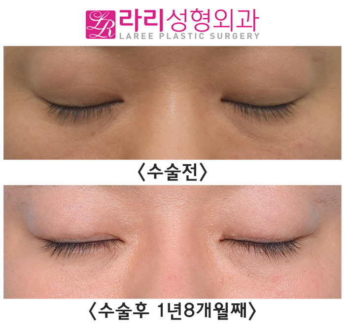 [Rari Plastic Surgery] Before and after surgery: removing a poorly lifting natural double eyelid to transform into a handsome-looking eye image 5