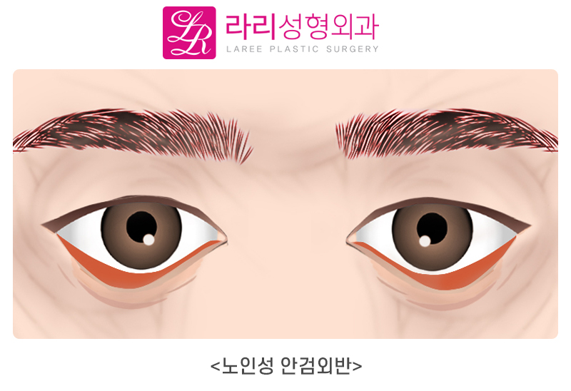 [라리성형외과] 노화로 나타나는 노인성 안검외반의 교정 관련 이미지 1