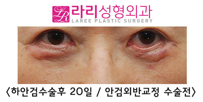[라리성형외과] 노화로 나타나는 노인성 안검외반의 교정 관련 이미지 4