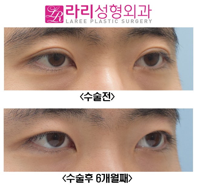[Rari Plastic Surgery] Eliminating Thick Double Eyelids with a Near-No-Double-Eyelid Inner Fold image 5