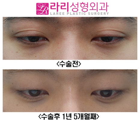 [Lari Plastic Surgery] Removing a Thick Natural Double Eyelid on Men image 5