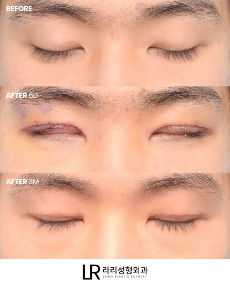 [Lari Plastic Surgery] Swelling After Double Eyelid Surgery: Why Does It Go Down Differently on Each Side? Will It Eventually Even Out? image 2