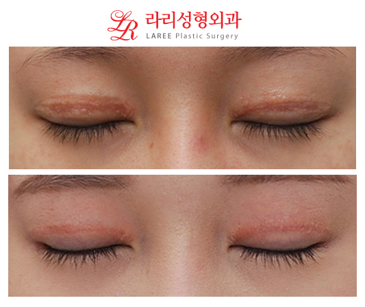 Revision Double Eyelid Surgery, Downward Outer Corner Epicanthoplasty Before and After Photos image 4