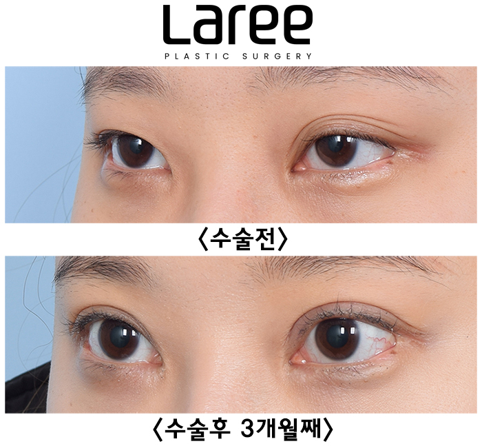 [Laree Plastic Surgery] One-Sided Release After Buried Double Eyelid Surgery, Multiple-Fold Double Eyelid Revision Surgery and Changes After Eyelid Correction image 3