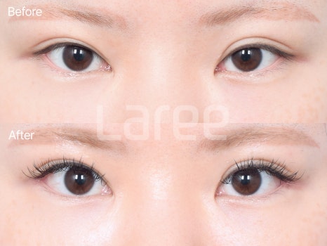 [LaLi Plastic Surgery] Outer Canthus Lowering Surgery, If It’s a Revision Surgery, It Must Be Done at a Place That Does It Well. image 9