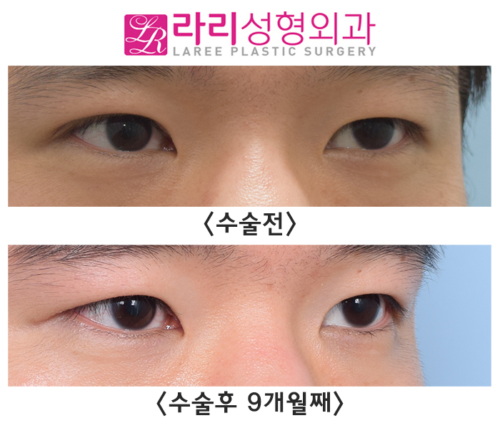[Rari Plastic Surgery] Revision Surgery to Remove a Double Eyelid Is Also Possible. image 3