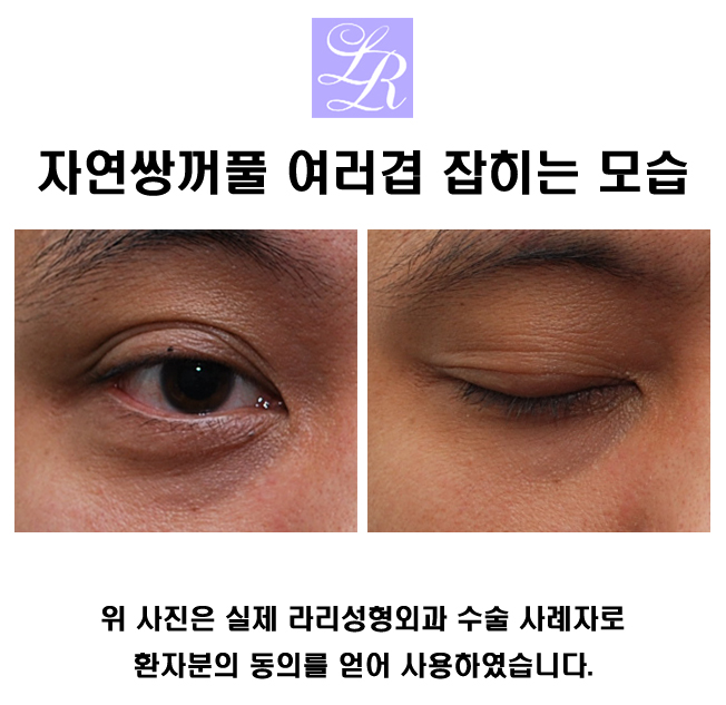 쌍꺼풀푸는수술이 쌍꺼풀없애는수술인가요? 관련 이미지 2