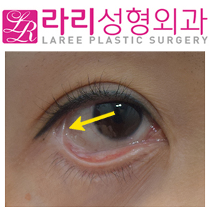 [라리성형외과] 뒤트임재수술,결막이식으로 뒤트임부작용(물갈퀴변형, web deformity) 교정하기 관련 이미지 2