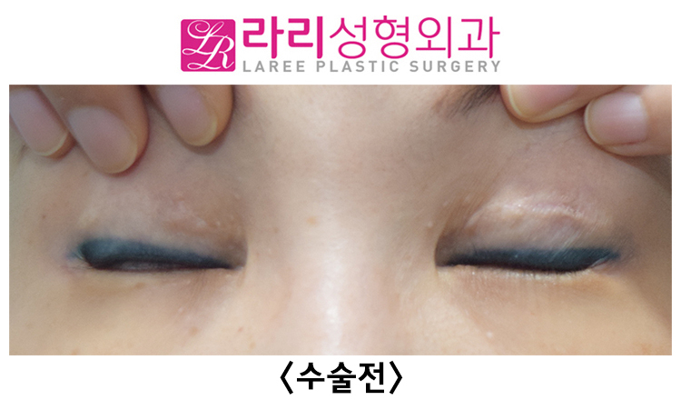 [라리성형외과] 여러 번 반복하지 않아도 되는 두꺼운 아이라인 문신 축소수술 전후 비교 관련 이미지 1