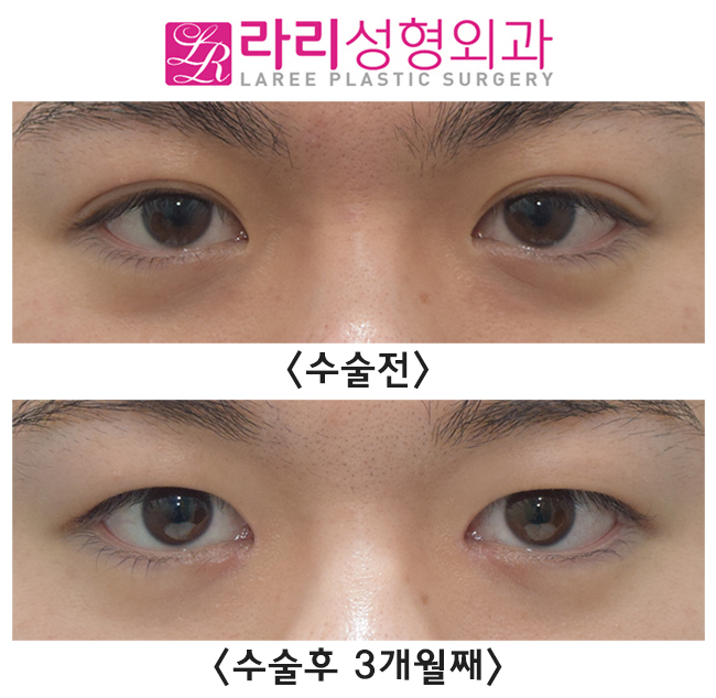 [라리성형외과] 남자다워지고 싶은 예쁜 자연 쌍꺼풀, 무쌍 만들기 관련 이미지 1