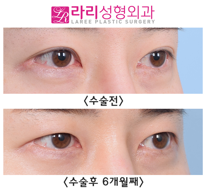 [라리성형외과] 매몰 쌍수 흉터 없애는데 쌍꺼풀없애는수술이 좋을지도?! 관련 이미지 1