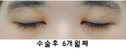 [라리성형외과] 절개쌍수 눈매교정 그리고 앞트임 관련 이미지 8
