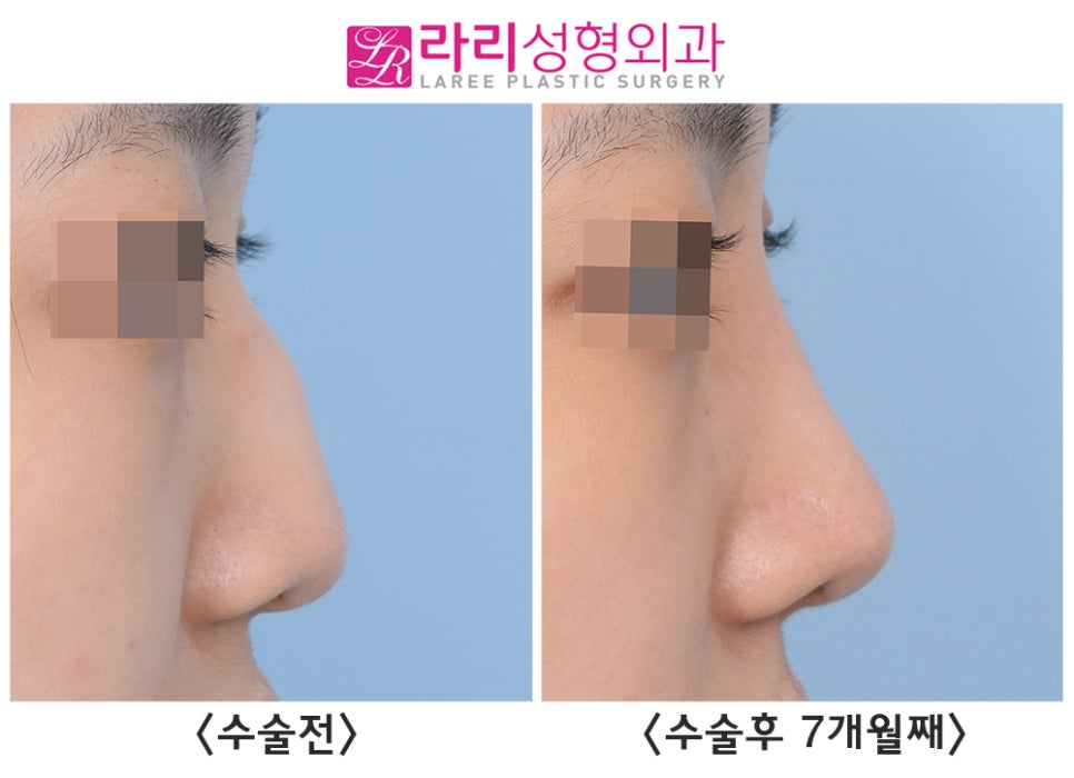 [라리성형외과] 선천성 매부리코, 첫코성형으로 고민하지 말고 매끄럽게 바꾸자 관련 이미지 2