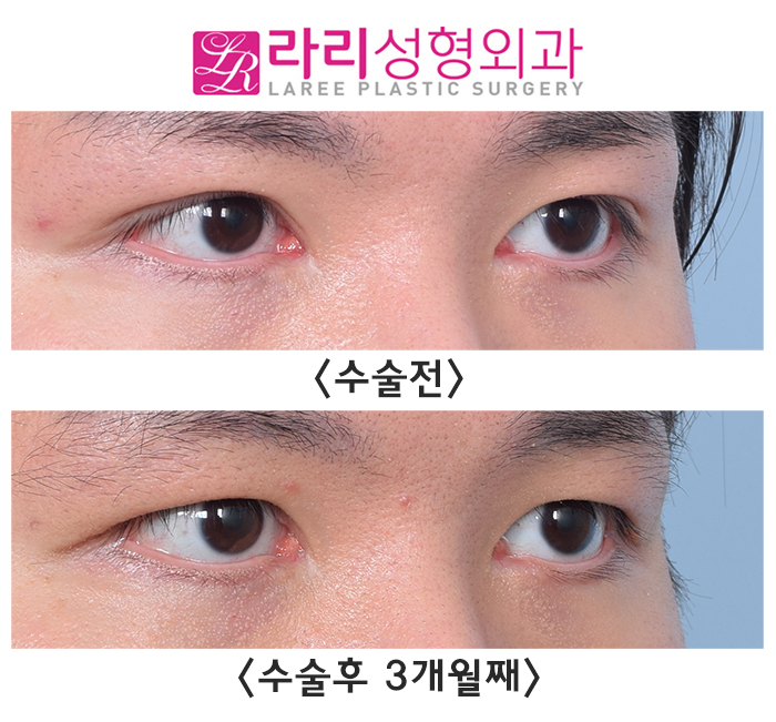[라리성형외과] 쌍수 흉터까지 없애는 쌍꺼풀없애기수술 전후 사진 보기 관련 이미지 3