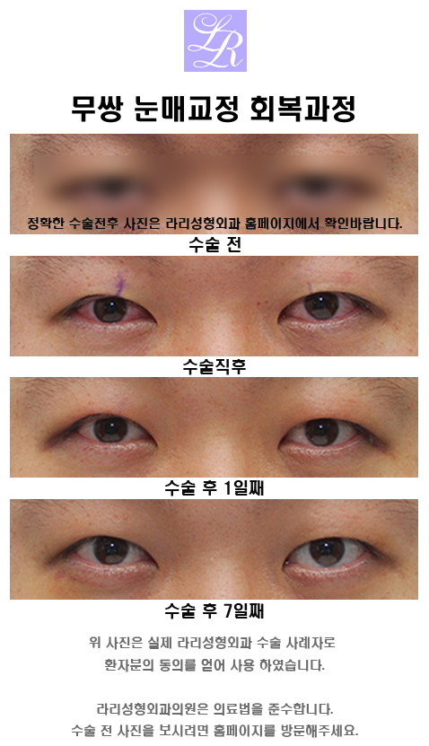 남자눈매교정, 무쌍이 대세 관련 이미지 4