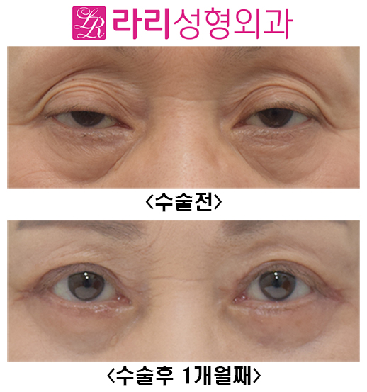 [Lari Plastic Surgery] Before and After Upper Blepharoplasty and Lower Blepharoplasty image 1