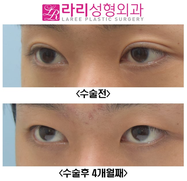 [라리성형외과] 쌍꺼풀없애기 그리고 눈두덩이 꺼짐 교정 (루프지방이식) 관련 이미지 5