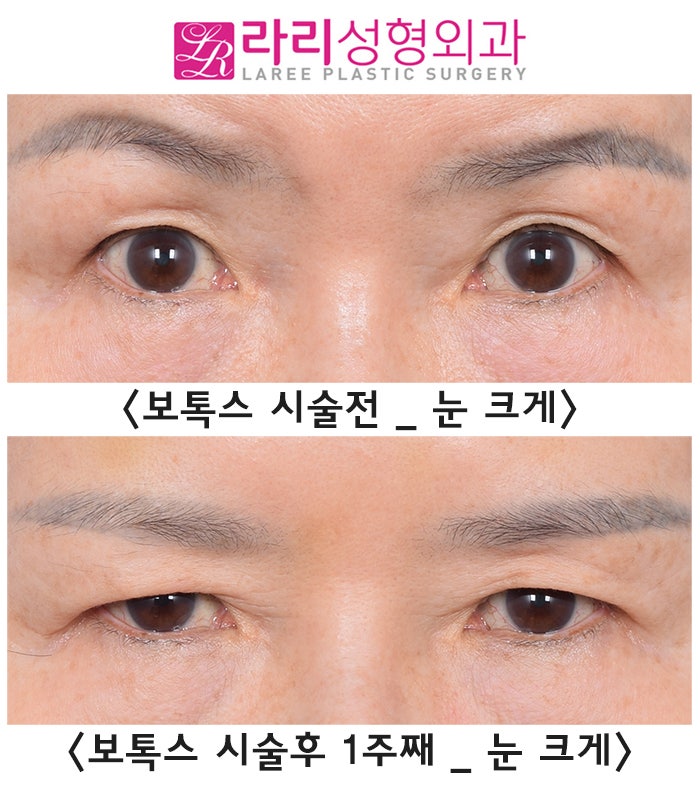 [Rari Plastic Surgery] Why You Should Get Forehead Botox Before Upper Blepharoplasty, as Seen in Before-and-After Photos image 2