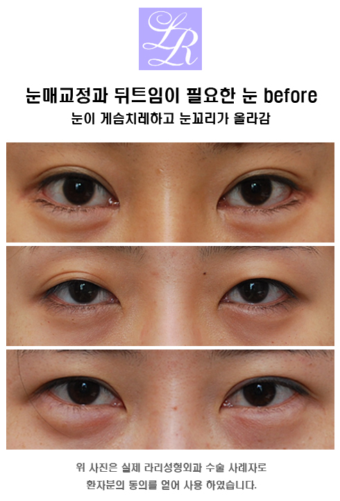 비절개눈매교정술, 그리고 눈 뒷트임 관련 이미지 5