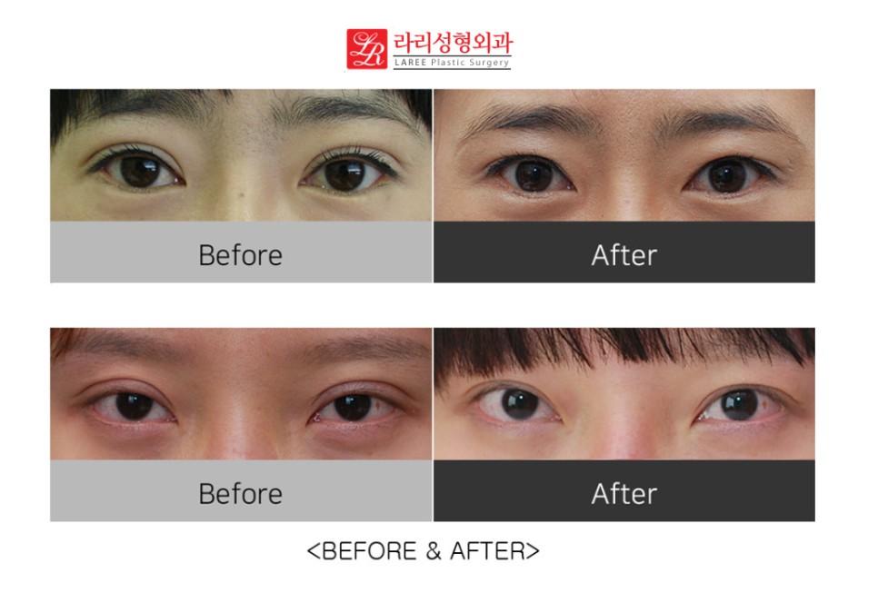 Correcting Double Eyelid Surgery Side Effects: Ectropion (feat. Rari Plastic Surgery) image 6