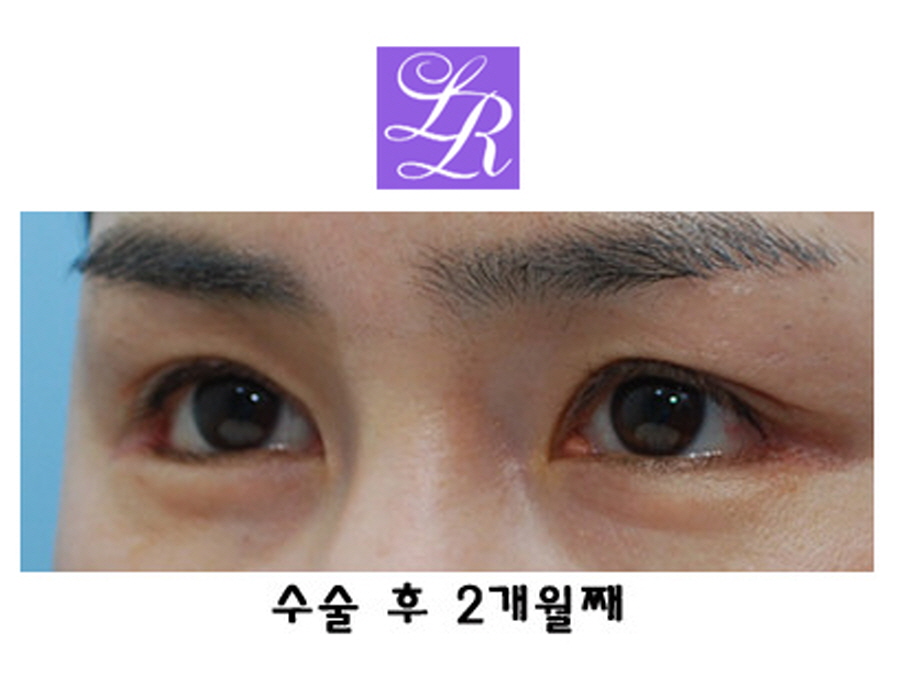 짝눈교정방법 중(쌍꺼풀재수술 + 눈매교정) 확인해야 될 사항 관련 이미지 5