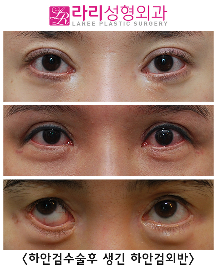 [Rari Plastic Surgery] The Most Common Complication of Lower Blepharoplasty: Lower Eyelid Ectropion image 2