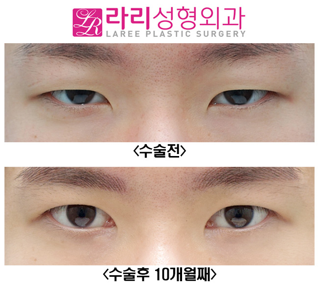 [Lari Plastic Surgery] Full Non-Incision Eye Correction, Effects and Before-and-After Photos (Different from Double Eyelid Surgery) image 4