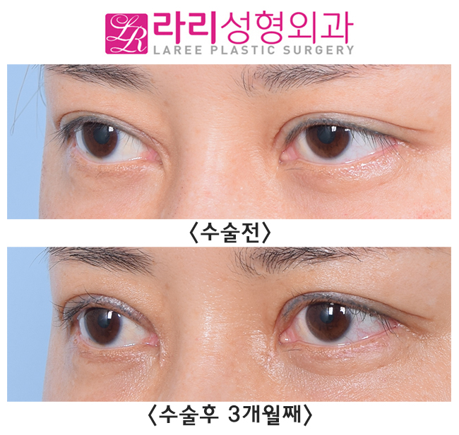 [Lari Plastic Surgery] Thick out-line double eyelids are best treated with double-eyelid revision surgery to lower the line, along with epicanthoplasty restoration!! image 3