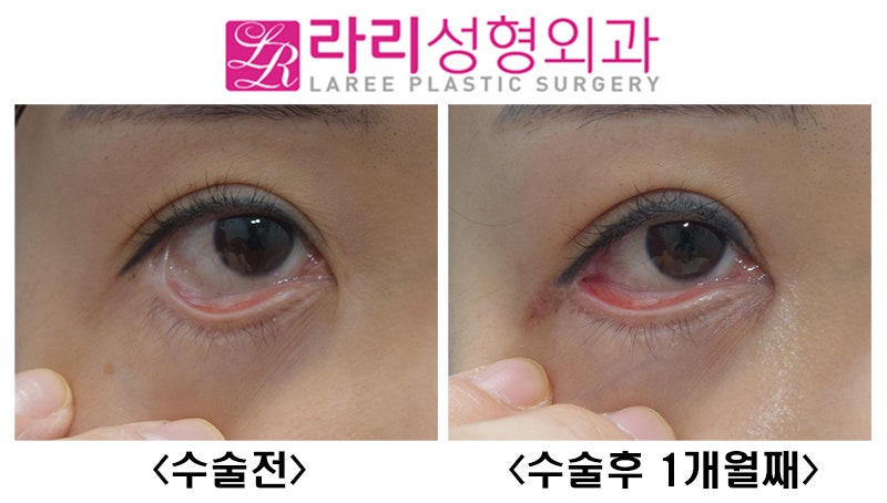 [라리성형외과] 뒤트임재수술,결막이식으로 뒤트임부작용(물갈퀴변형, web deformity) 교정하기 관련 이미지 5
