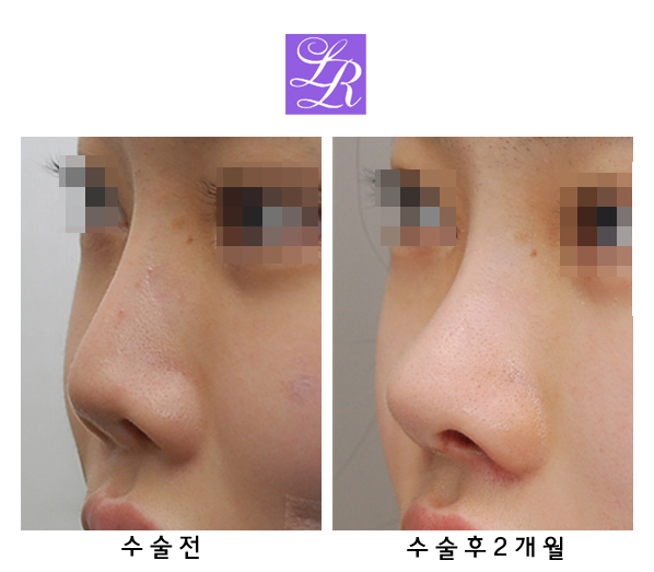 Short Upturned Nose Revision Surgery: Rib Cartilage Is Essential! (feat. Alar Reduction) image 3