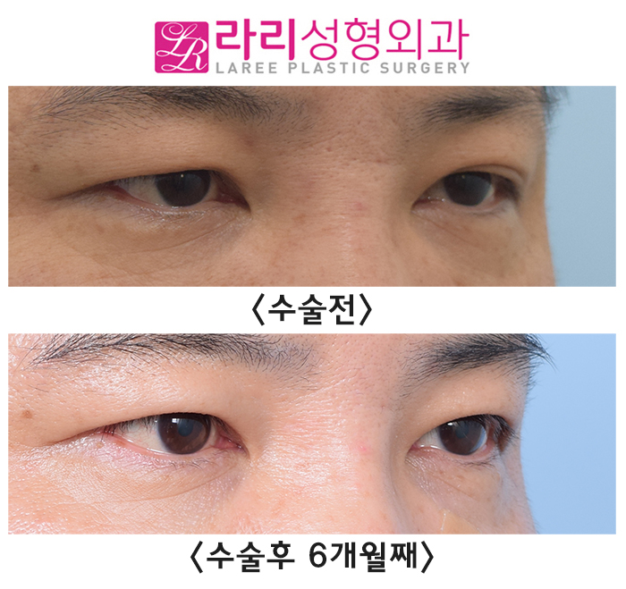 [Rari Plastic Surgery] Before and After Surgery to Remove Uneven Natural Double Eyelids Accompanied by Sagging Skin image 2