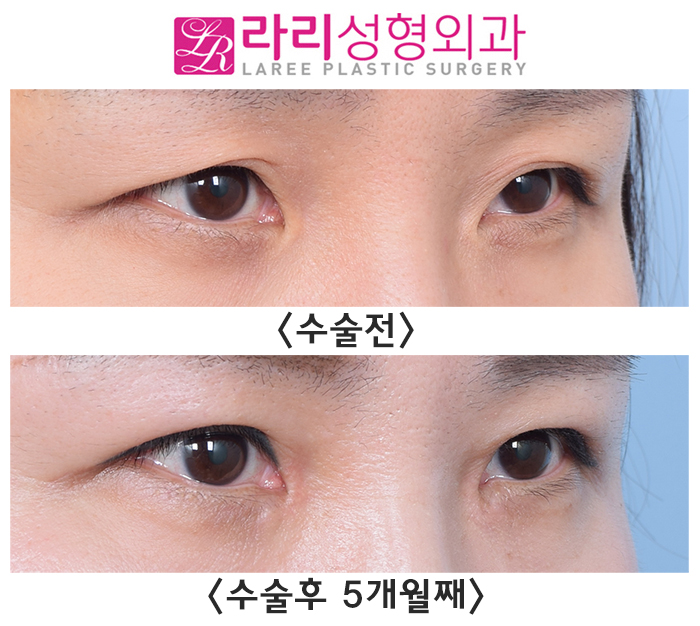 [라리성형외과] 자연스러운 속쌍꺼풀 절개눈매교정, 앞트임수술 전후사진 관련 이미지 2