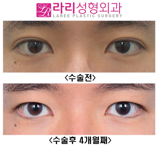 [라리성형외과] 성공적인 쌍꺼풀없애는수술 전후 사진과 효과 관련 이미지 1