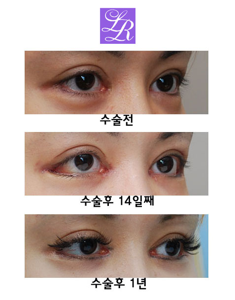Simultaneous Medial and Lateral Canthoplasty Revision image 3