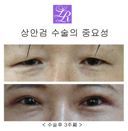 상안검수술, 하안검수술- 수술전후, 경과 궁금쓰 관련 이미지 1