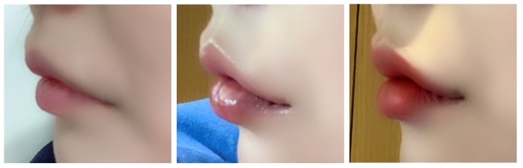 How to Make the Corners of the Mouth Lift Beautifully with Lip Corner Filler image 11