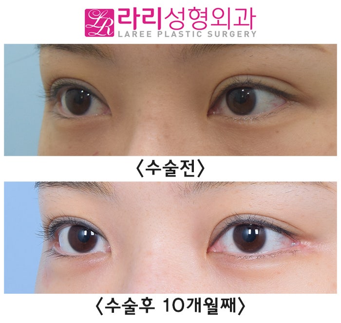 [Lari Plastic Surgery] Before-and-After Photos of Double Eyelid Revision Surgery and Lateral Canthoplasty Revision Surgery That Leave Nothing Out image 4