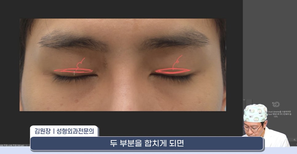 [라리성형외과] 쌍꺼풀재수술 라인 낮추는 두 가지 수술법 (절제방법 , 두줄따기방법) 관련 이미지 6