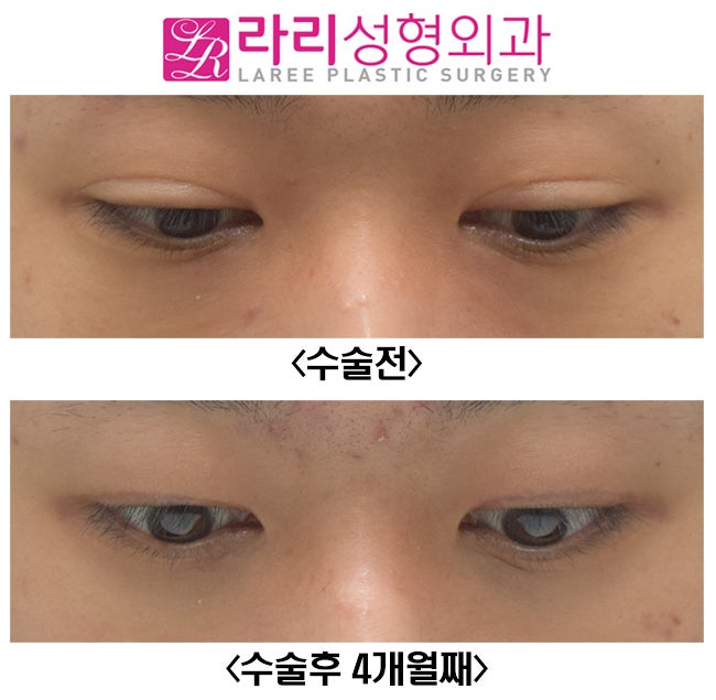 [라리성형외과] 쌍꺼풀없애기 그리고 눈두덩이 꺼짐 교정 (루프지방이식) 관련 이미지 7