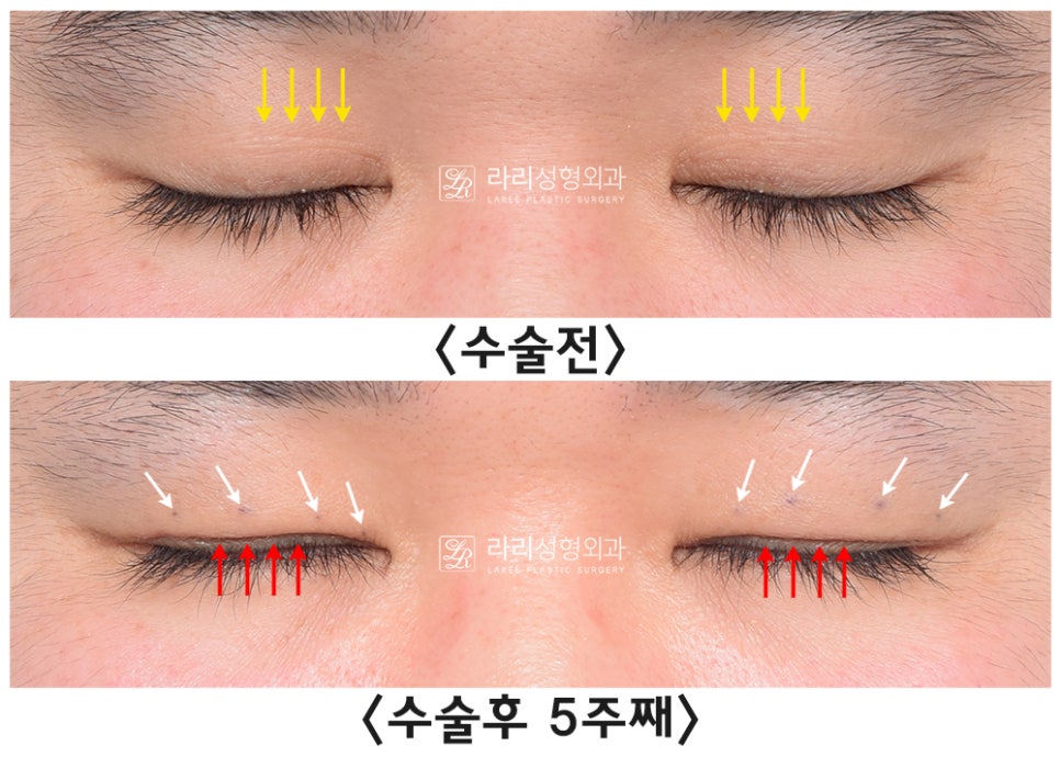 [라리성형외과] 무절제 겉쌍꺼풀없애기 무쌍수술 전후 (+절개와 절제의 차이) 관련 이미지 4