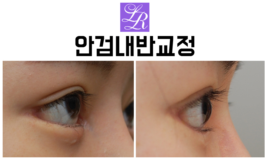 Can Lower-Eyelid Surgery and Entropion Correction Be Done at the Same Time? image 6