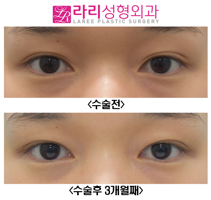 [Lari Plastic Surgery] Reducing the Double Eyelid Line from an Outline to an Inline for a Natural Look image 1