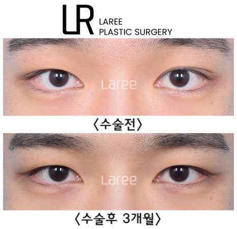 [라리성형외과] 쌍꺼풀없애는 무쌍 수술, 쌍꺼풀라인 낮추기가 아닙니다. (완전무쌍과 무쌍속쌍 그 차이) 관련 이미지 2