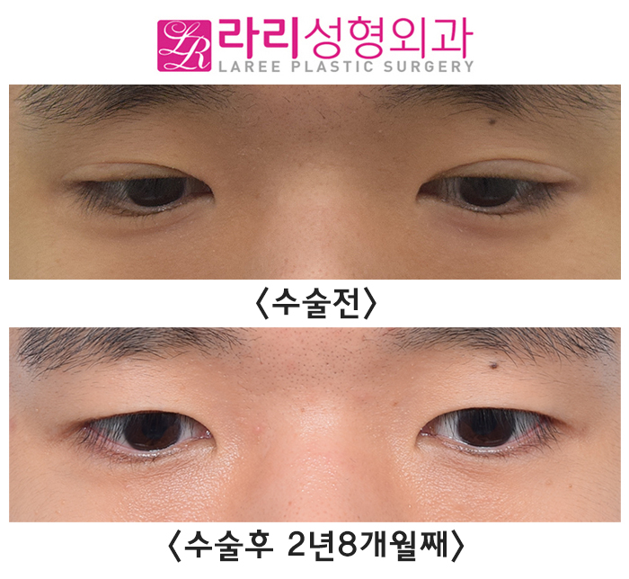 [Lari Plastic Surgery] Removing Eyelid Creases: Eyes Not Closing Fully, Side Effects, Recovery, Before-and-After Photos image 2