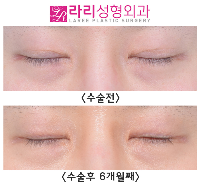 [라리성형외과] 매몰 쌍수 흉터 없애는데 쌍꺼풀없애는수술이 좋을지도?! 관련 이미지 3