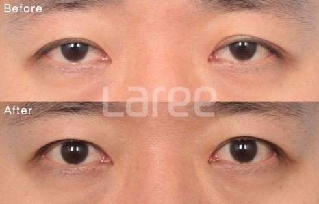 [Lari Plastic Surgery] Everything About Double Eyelid Removal Surgery image 4