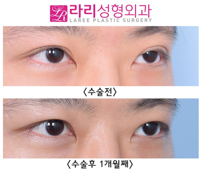 [라리성형외과] 쌍꺼풀없애는수술 한 달 차, 효과와 경과가 이 정도라고요?! 관련 이미지 2