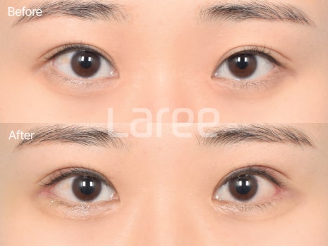 [LaLi Plastic Surgery] Outer Canthus Lowering Surgery, If It’s a Revision Surgery, It Must Be Done at a Place That Does It Well. image 4