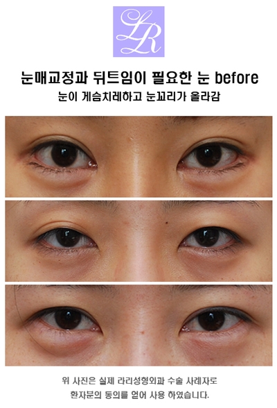 뒤트임 눈매교정 함께 관련 이미지 2