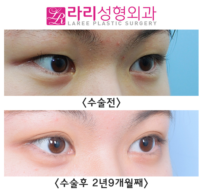 [라리성형외과] 쌍수와 앞트임으로 성숙한 이미지 만들기 관련 이미지 3